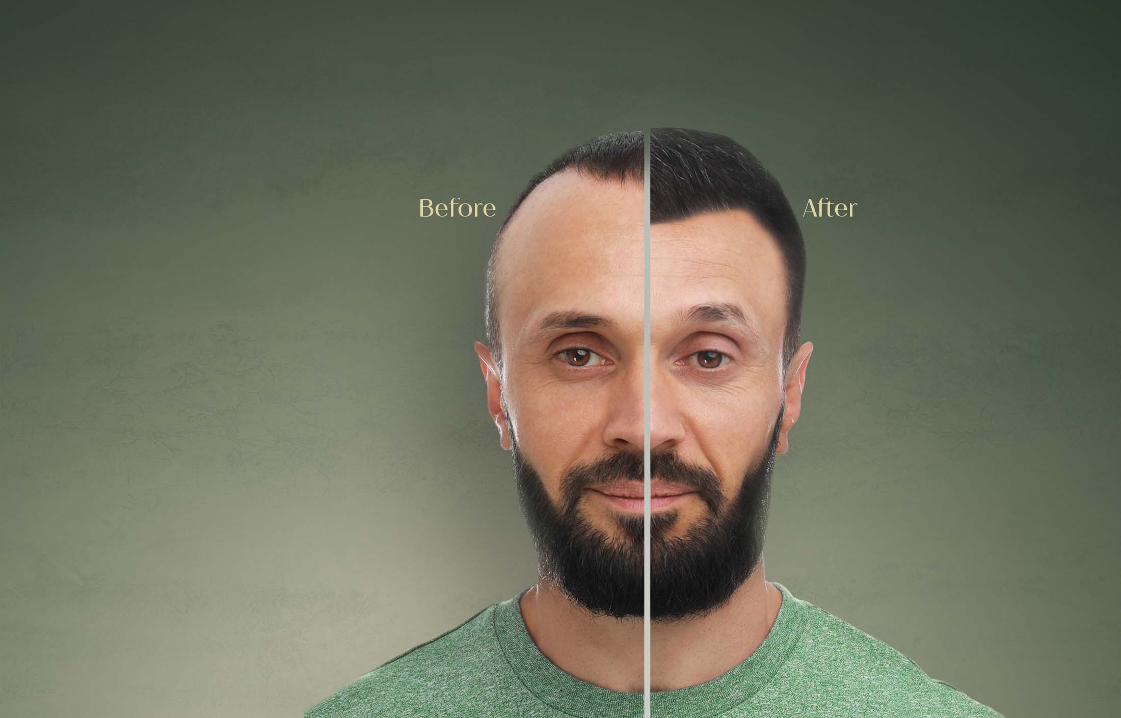 Haartransplantatie voor en na World Scalp Clinic